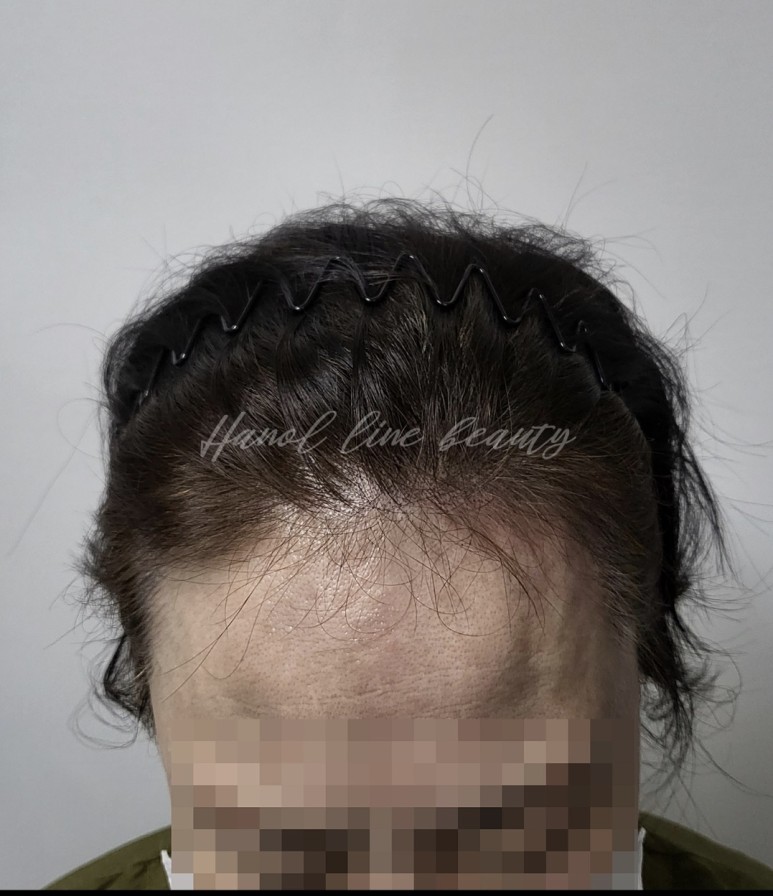 헤어라인
