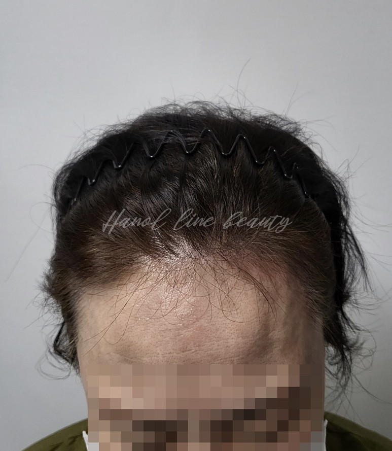 헤어라인