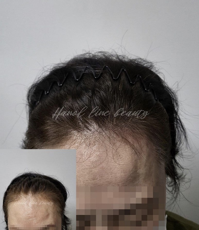 여성두피문신