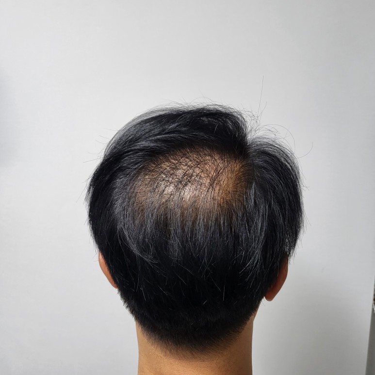 의정부smp두피문신
