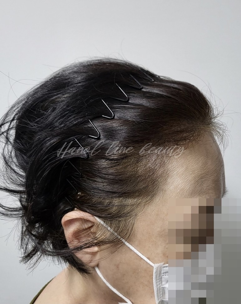 여성두피탈모