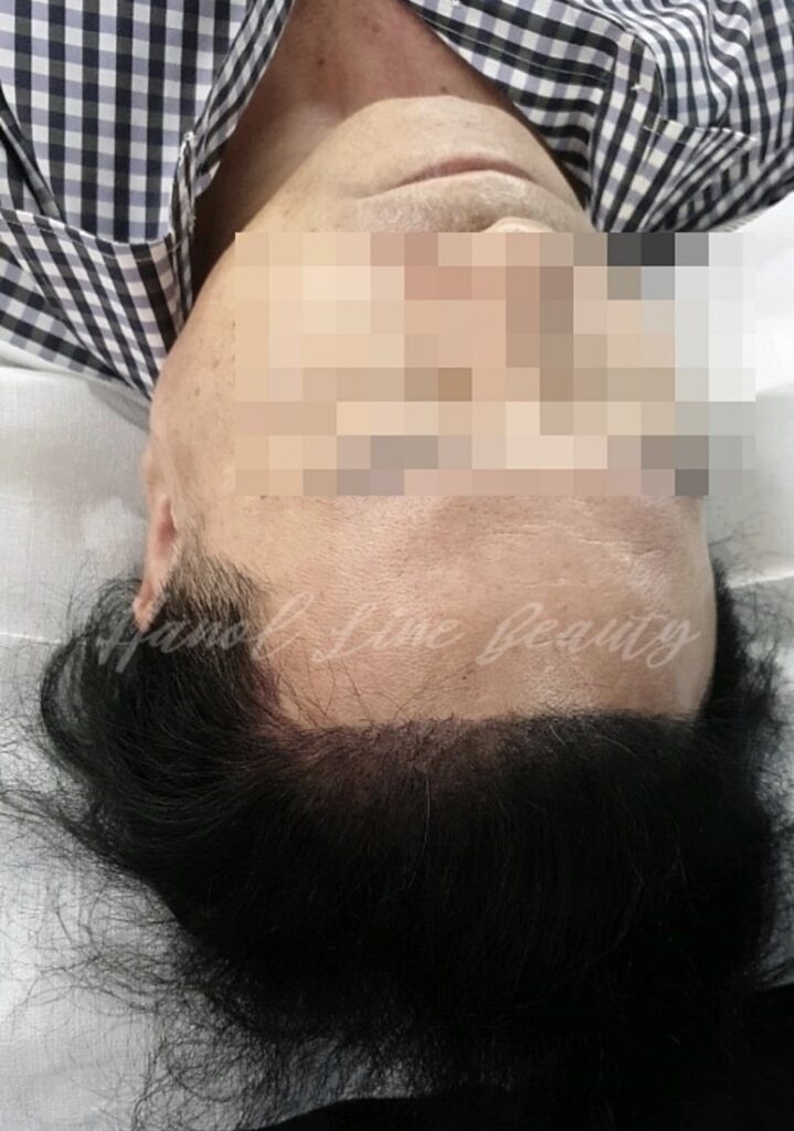 두피문신가격