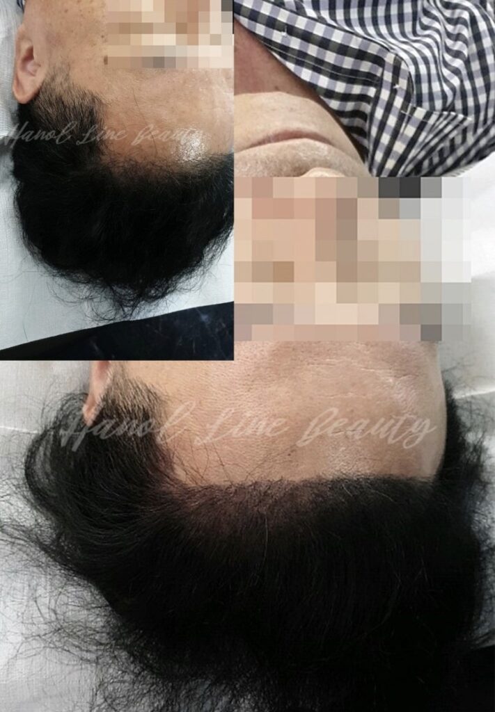 두피문신부작용