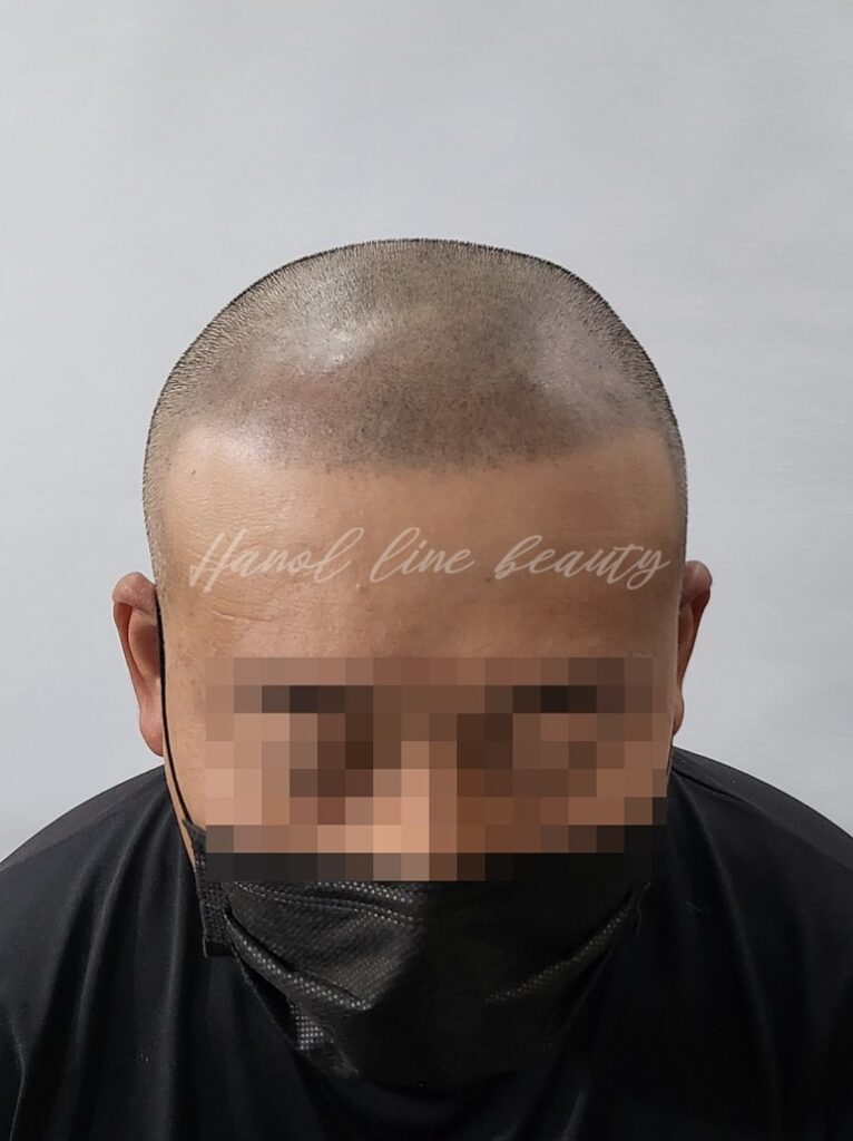 두피문신잘하는곳
