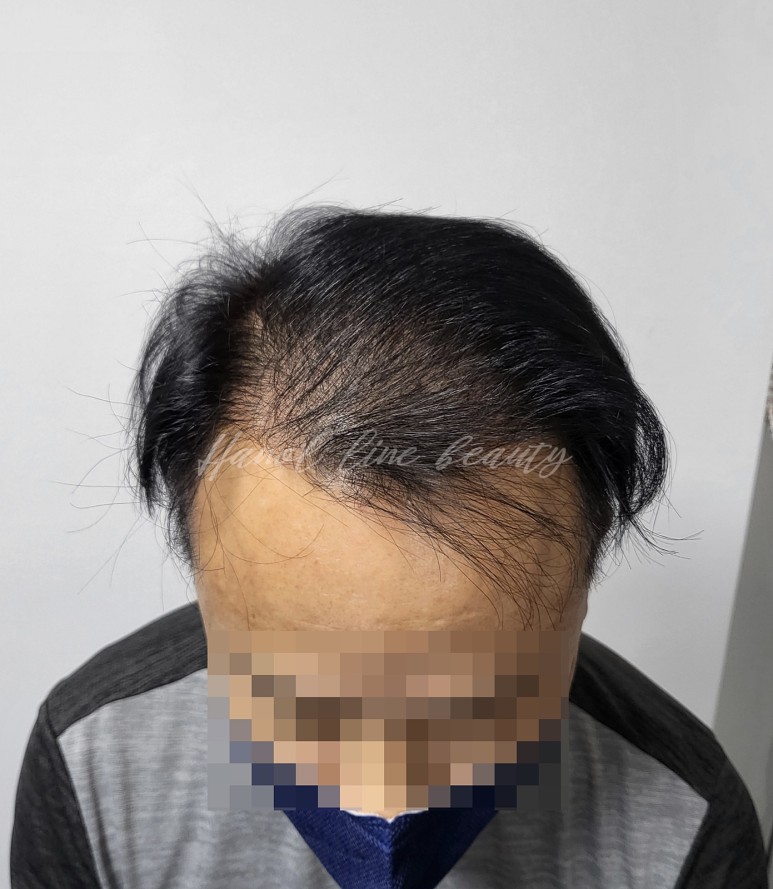 정수리두피문신