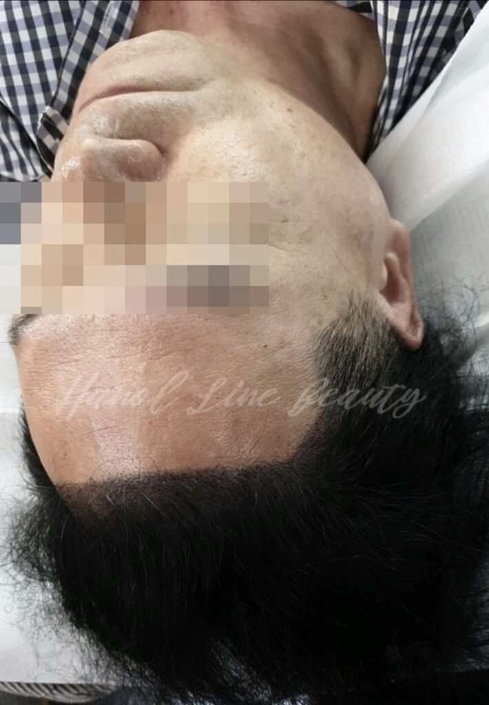 일산두피문신