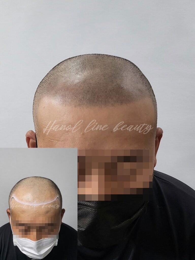 운양동두피문신