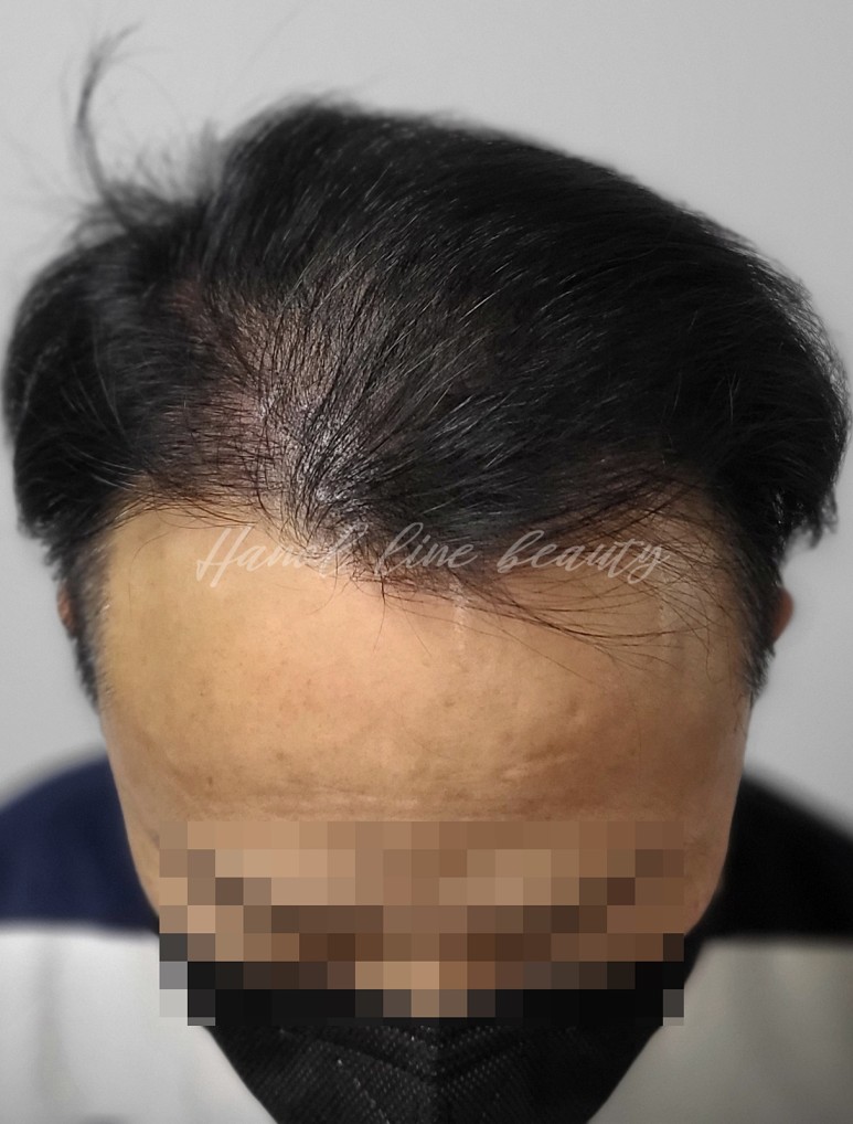 장항동두피문신