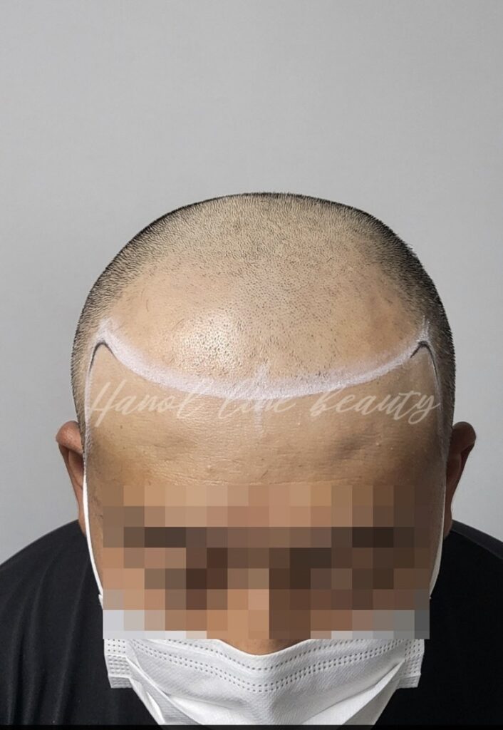 김포두피문신