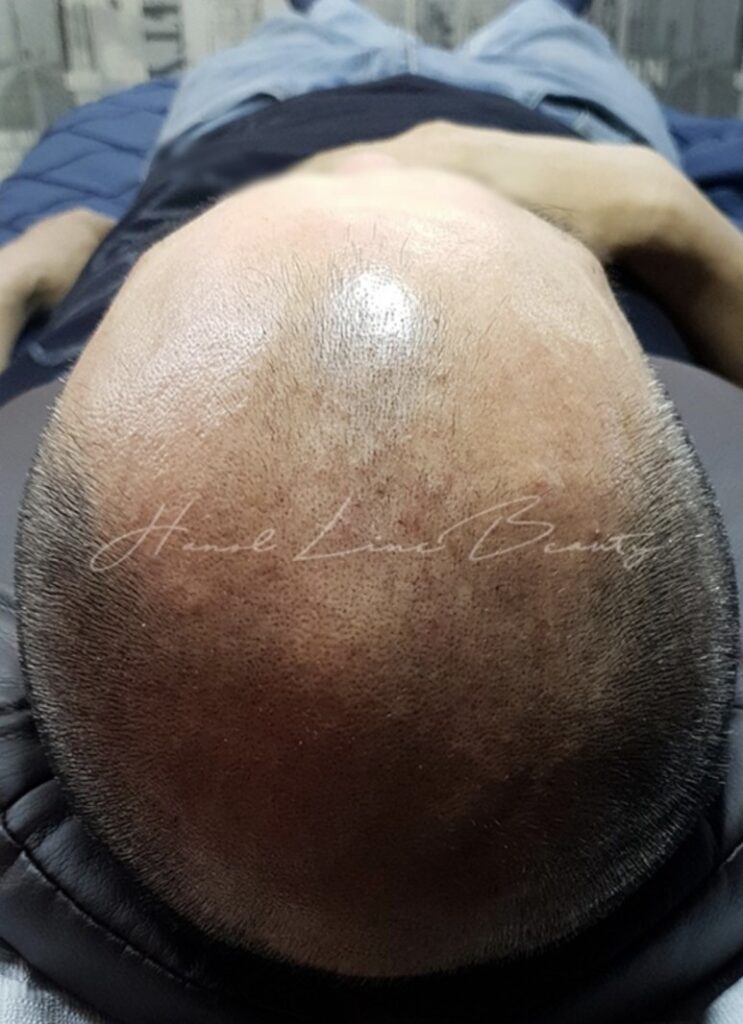일산두피문신