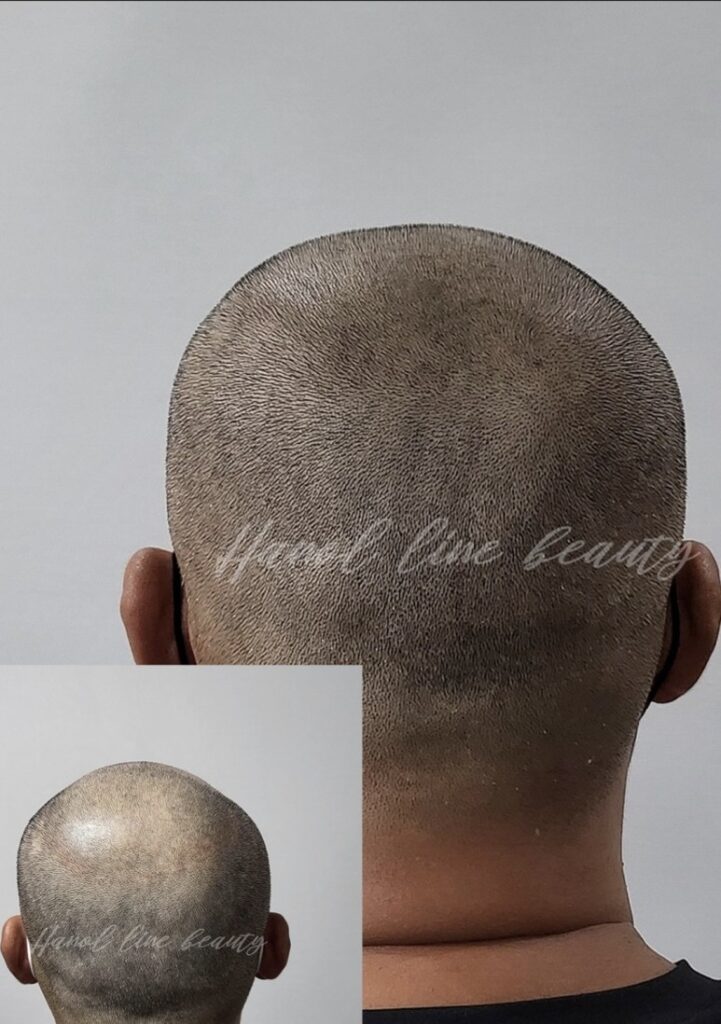 장기동두피문신