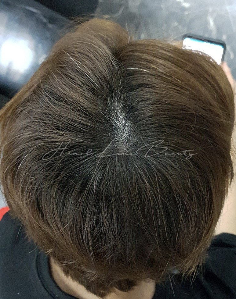 민락동두피문신