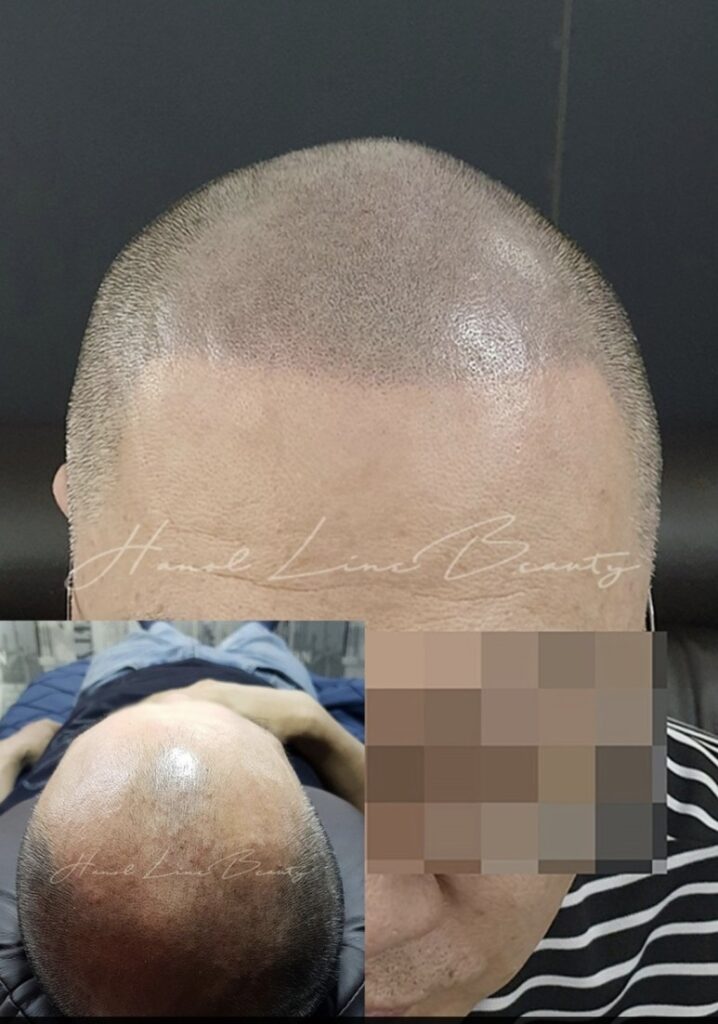 대머리문신