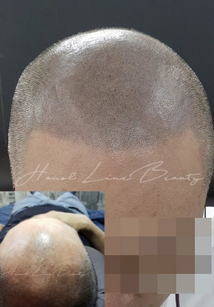 smp두피문신