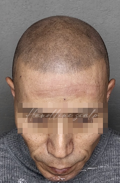 일산두피타투