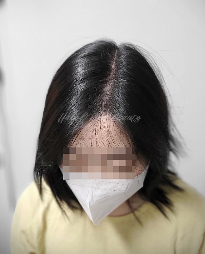 인천두피문신
