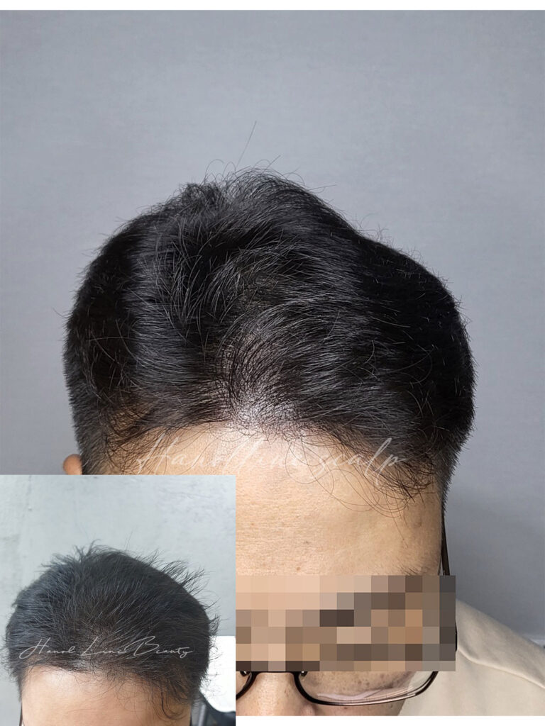 김포두피문신잘하는곳