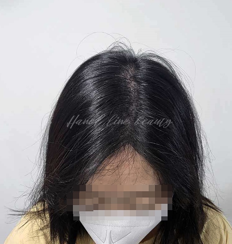 김포두피문신