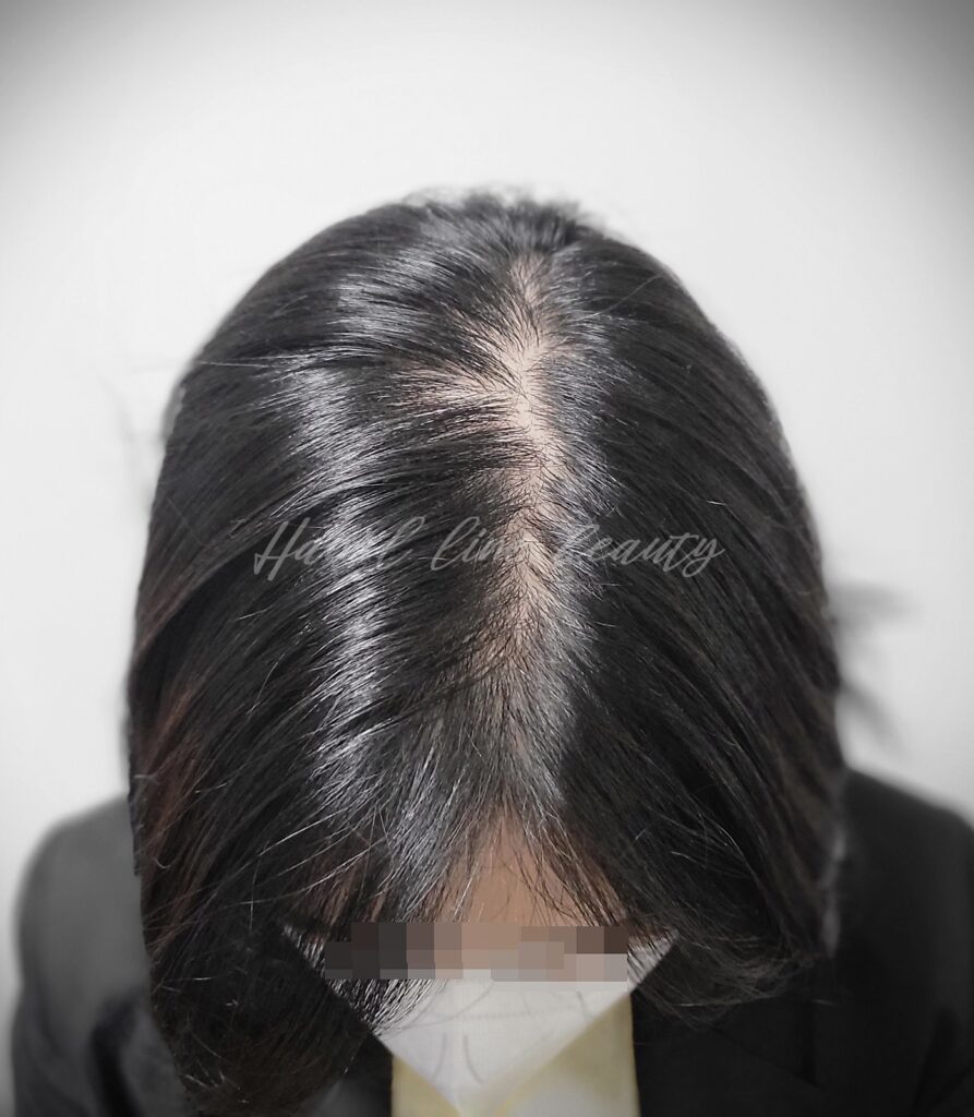 일산두피문신